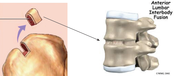 前路脊椎融合手術